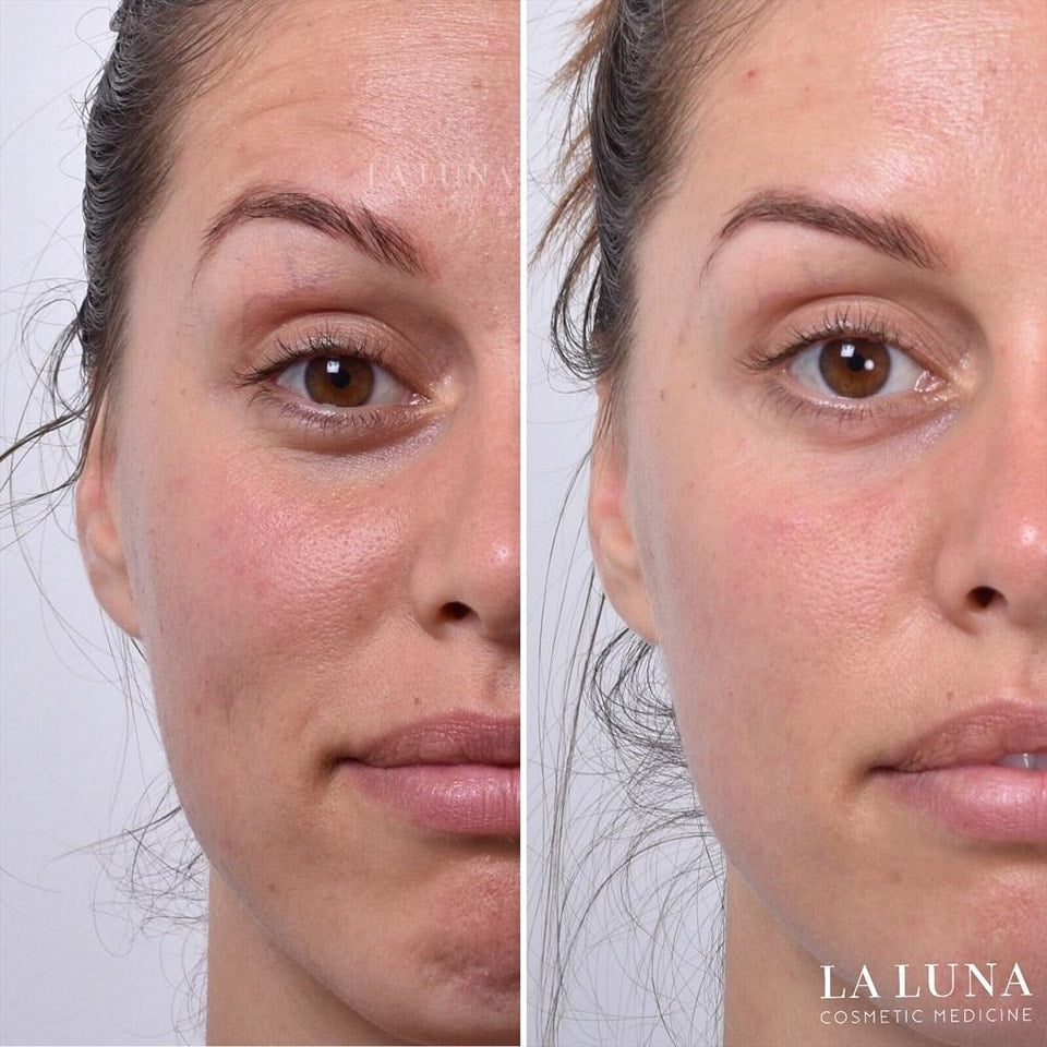 “Strong Pulse Cosmetic Wrinkle Reducer – Advanced Anti-Aging Skin Tightening Device”