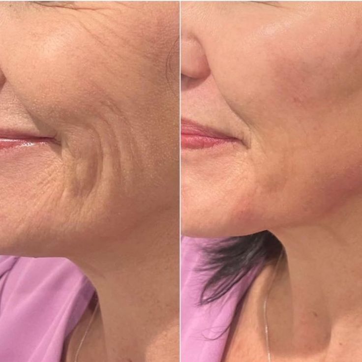 “Strong Pulse Cosmetic Wrinkle Reducer – Advanced Anti-Aging Skin Tightening Device”