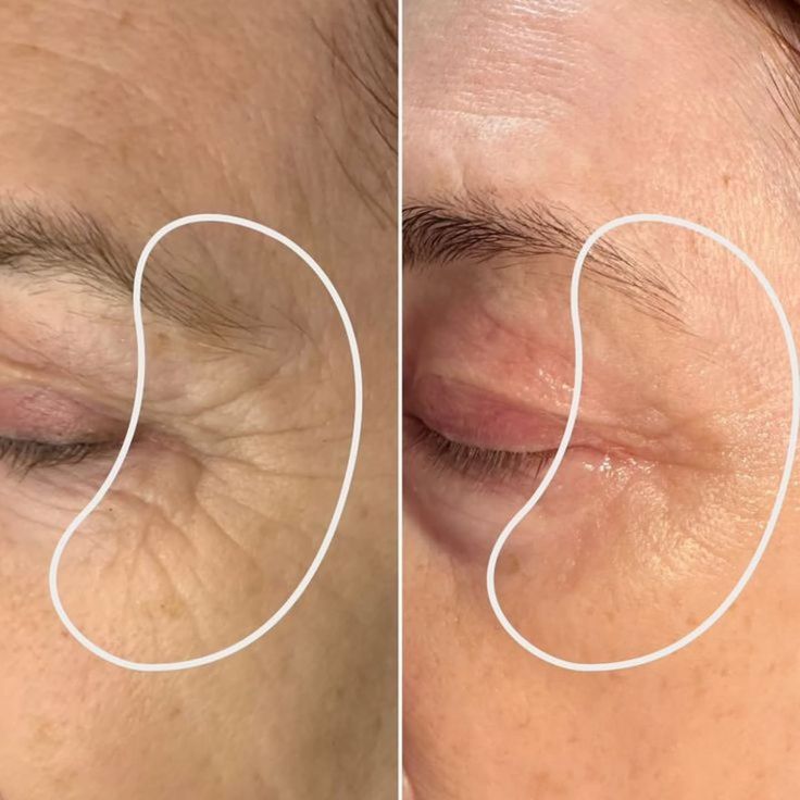 “Strong Pulse Cosmetic Wrinkle Reducer – Advanced Anti-Aging Skin Tightening Device”